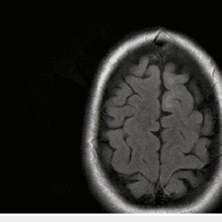 Mri Thoracic Spine With And Without Contrast Shows Diffuse Abnormal