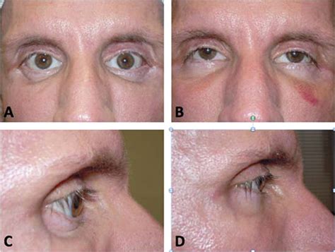 Problems With My Eyes And Relation To Mental Stat Health And Recovery