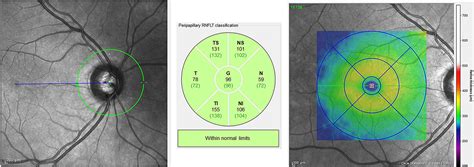 Correlation Between Corneal And Retinal Neurodegenerative Changes And