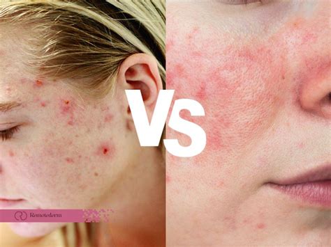 Navigating The Landscape Of Skincare For Acne Rosacea A Comprehensive