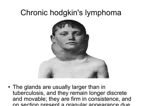 Hodgkins Lymphoma Ppt Free Download