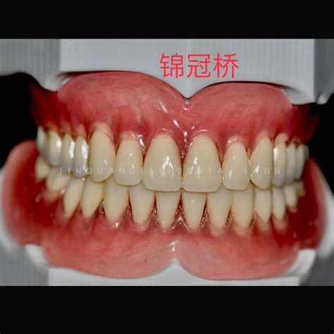 Dental Removable Complete Denture Ivoclar Full Denture Acrylic Teeth