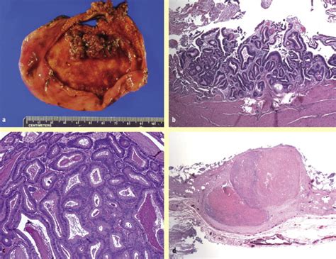 Benign Tumors And Tumor Like Lesions Of The Gallbladder And