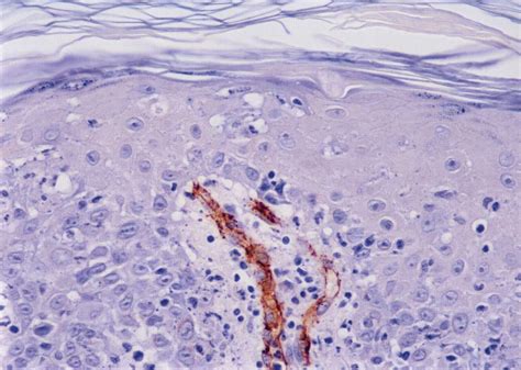 The Immunopathology Of Regression In Benign Lichenoid Keratosis