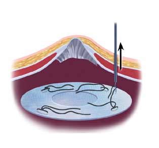 Hernia Types Ventral