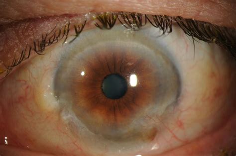 Moran CORE Limbal Stem Cell Deficiency Image Report