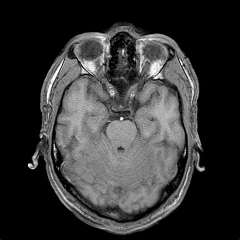 Radiologia Rmc Koda Isquemia Cerebelosa