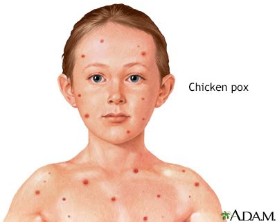 Chickenpox UF Health