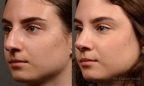 Rhinoplasty Before And After Case 458 Toronto Rhinoplasty Surgery