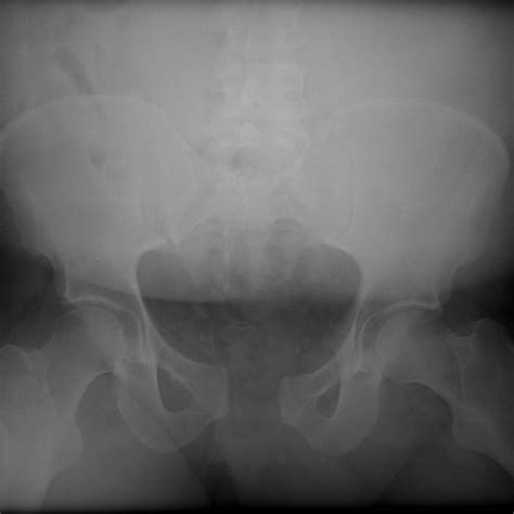 Presenting AP Pelvis Radiograph Demonstrating The Open Book Pelvic