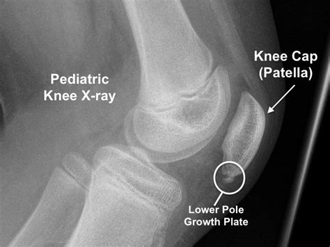 Sinding Larsen Johansson Syndrome Knee