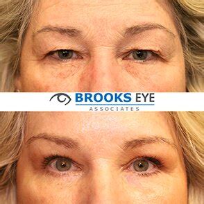 Blepharoplasty Eyelid Surgery In Plano Tx Brooks Eye Associates