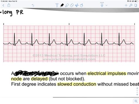 EKGs Flashcards Quizlet