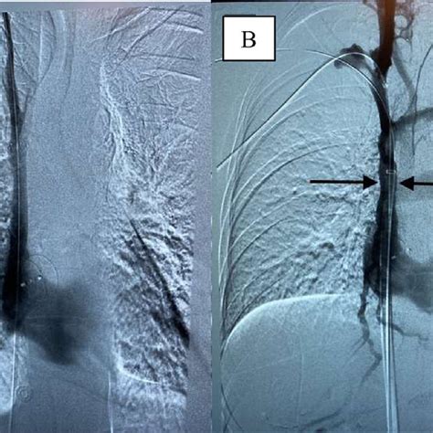 X Ray Venography Showing A Non Obstructed Svc Post Thrombectomy A Download Scientific