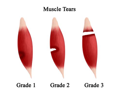 Muscle Strain–Torn Muscle–Muscle Tear - OrthoEducation