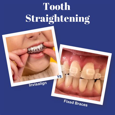 Invisalign Vs Fixed Braces Brucegate Dental Practice