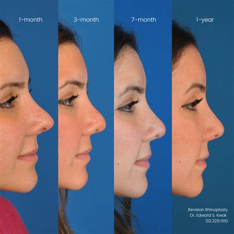 Patients Healing Journey After Revision Rhinoplasty