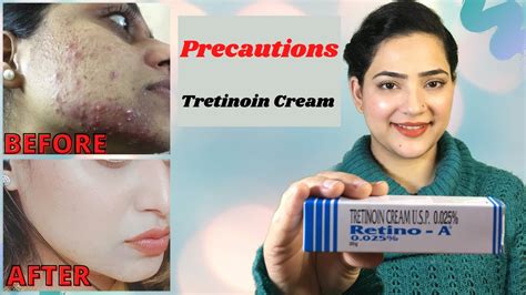 Retino A 0 025 Cream Before And After Tretinoin Cream Precautions My Experience With