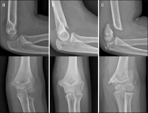 The Gartland Classification For Expediting Supracondylar Humerus