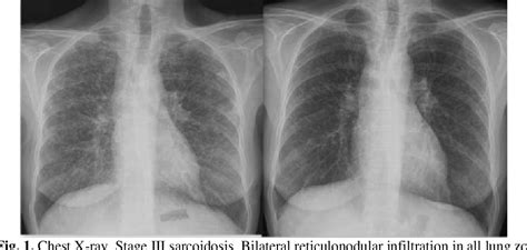 Figure 1 From A Stepwise Diagnosis Of Sarcoidosis Presenting With Renal