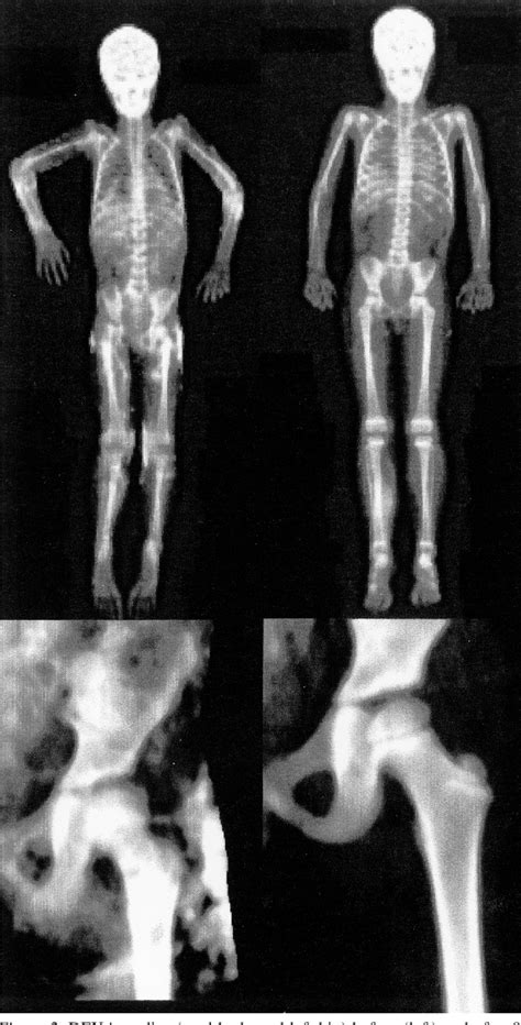 Figure From Rapid Improvement Of Calcinosis In Juvenile