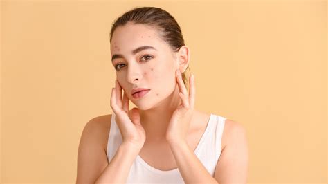 Adult Hormonal Acne