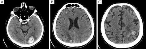 Unenhanced Axial Brain Ct Images With Multiple Lesions In Both