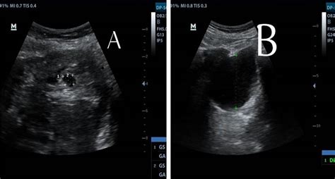 Ruptured Tubal Ectopic Pregnancies After Btl Imcrj