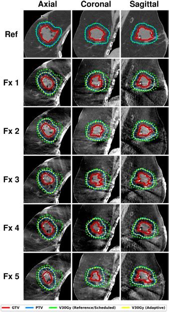 Improved Dosimetry And Plan Quality For Accelerated Partial Breast