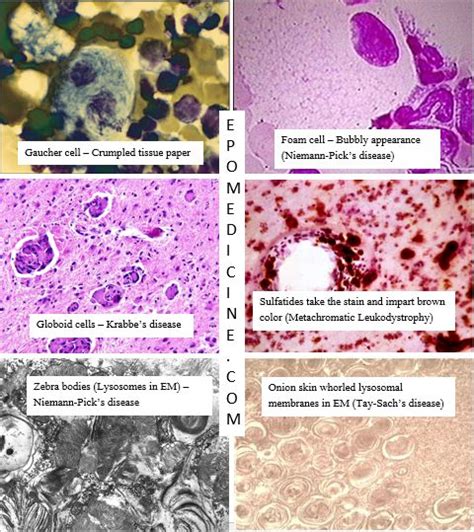 Lysosomal Storage Disease Mnemonic Usmle - My Bios