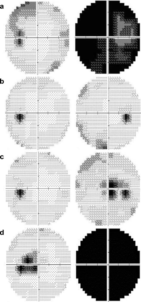 Visual Field Test Results At Each Episode A At The First Episode Of