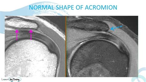 THREE TYPES OF ACROMIAL SPURS ON MRI: WHERE TO LOOK AND WHAT TO LOOK FOR - Radedasia