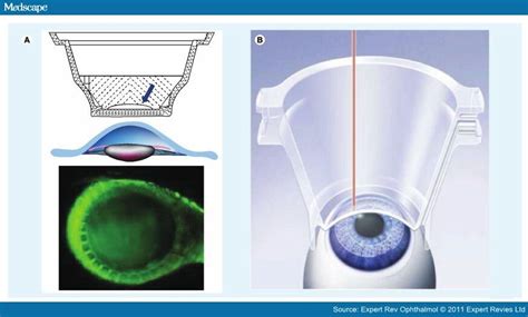 Refractive Surgery Comparison Of Femtosecond Lasers Page 3