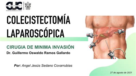 Colecistectomia Laparoscopica Angel Sedano Youtube