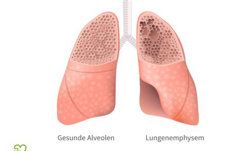 Lungenemphysem Symptome Therapie Lebenserwartung Onmeda De