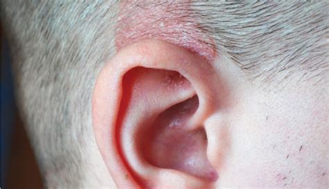 How To Treat Scabs On The Scalp