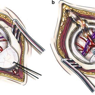 Illustration Of The Mis Eds Technique For Combined Revascularization