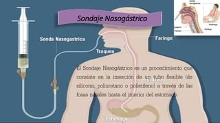 Sonda Nasogástrica Sonda Vesical Sonda Rectal pptx