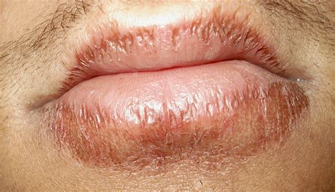 Cheilitis Wikipedia