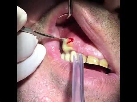 How to drain a gum abscess | News | Dentagama