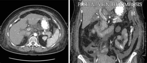 Ct Abdomen Showing Thrombus In The Portal Vein Coronal Open I