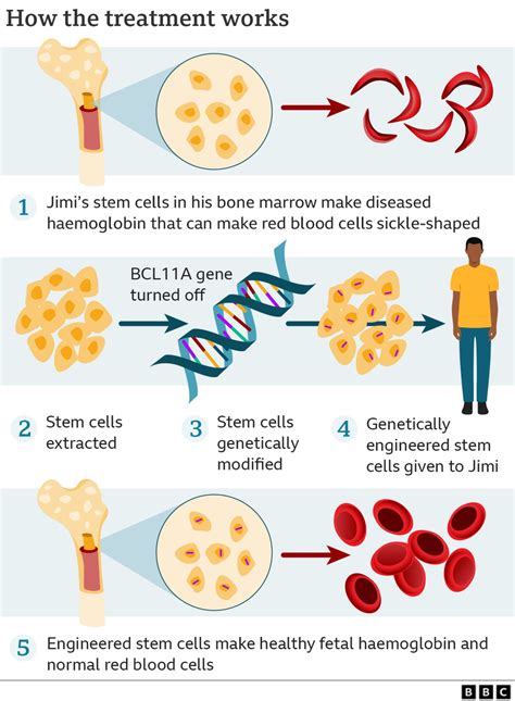 Casgevy UK Approves Gene Editing Drug For Sickle Cell BBC News