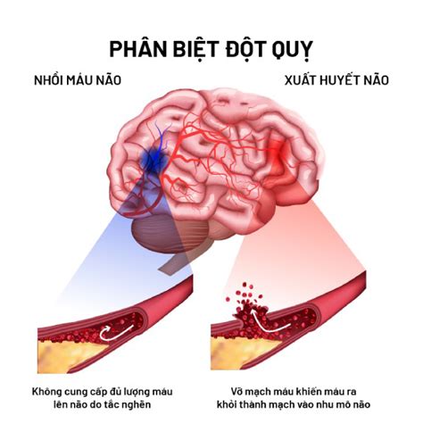 TỔNG QUAN VỀ ĐỘT QUỴ THÙY ĐỈNH TRIỆU CHỨNG CÁCH ĐIỀU TRỊ VÀ PHÒNG