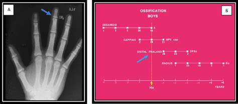 A Hand Wrist Film Showing Skeletal Maturation Stage Dpu Indicated By Download Scientific