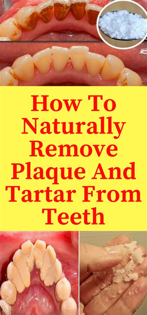 Daily Health Advisor How To Naturally Remove Plaque And Tartar From Teeth