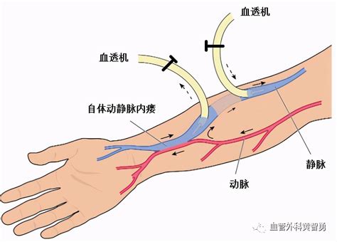 血管通路——透析患者的生命线血管静脉内 健康界