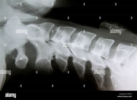 Healthy Cervical Spine Xray