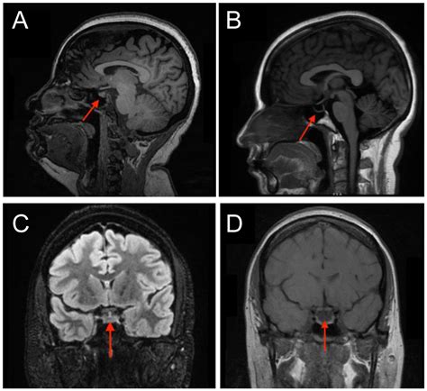 Idiopathic Intracranial Hypertension Mri