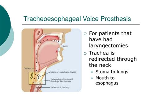 Ppt Tracheoesophageal Puncture Voice Prosthesis Tep Vp And Speaking