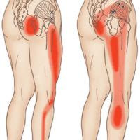 Self Care for Hip and Glute Pain? Call West Suburban Pain Relief at 630 ...